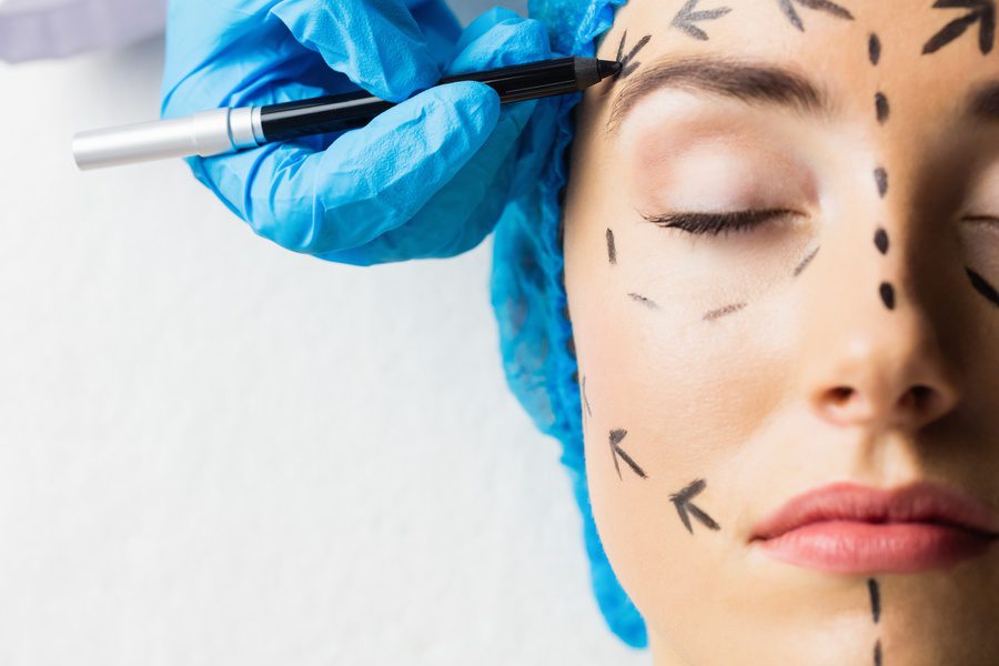 young patient with dotted lines on the face made by plastic surgeon for plastic surgery