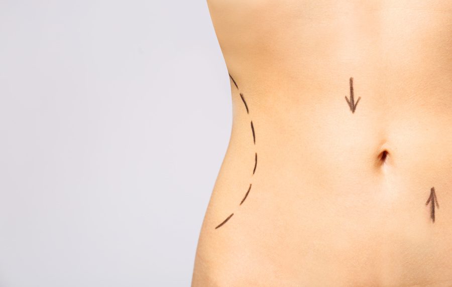 female belly marked for body contouring