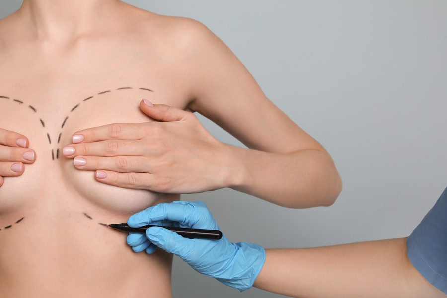 Doctor drawing marks on female breast for cosmetic surgery operation
