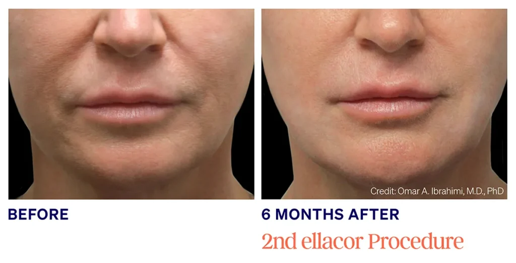 Ellacor micro-coring wrinkle treatment before and after Delray Beach